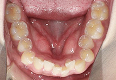 歯並びガタガタの矯正治療前