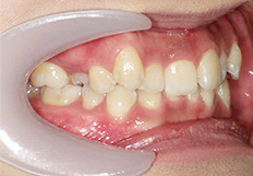 歯並びガタガタの矯正治療前
