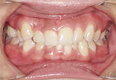 歯並びガタガタの矯正治療前