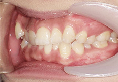 歯並びガタガタの矯正治療前