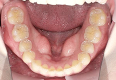 歯並びガタガタの矯正治療後