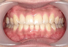 歯並びガタガタの矯正治療後