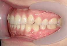 歯並びガタガタの矯正治療後