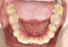 嚙み合わせの矯正治療前