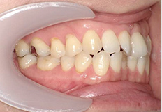 嚙み合わせの矯正治療前