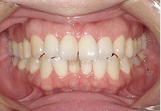 嚙み合わせの矯正治療前