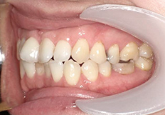 嚙み合わせの矯正治療前