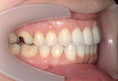 噛み合わせの矯正治療後