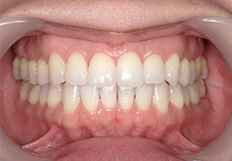 噛み合わせの矯正治療後