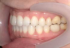 噛み合わせの矯正治療後