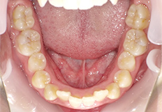 前歯の重なり矯正治療前