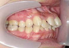 前歯の重なり矯正治療前