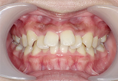 前歯の重なり矯正治療前