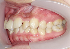 前歯の重なり矯正治療前