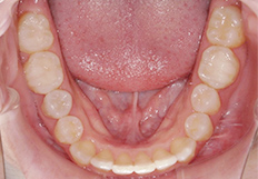 前歯の重なり矯正治療後