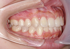 前歯の重なり矯正治療後