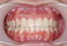 前歯の重なり矯正治療後