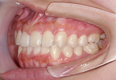 前歯の重なり矯正治療後