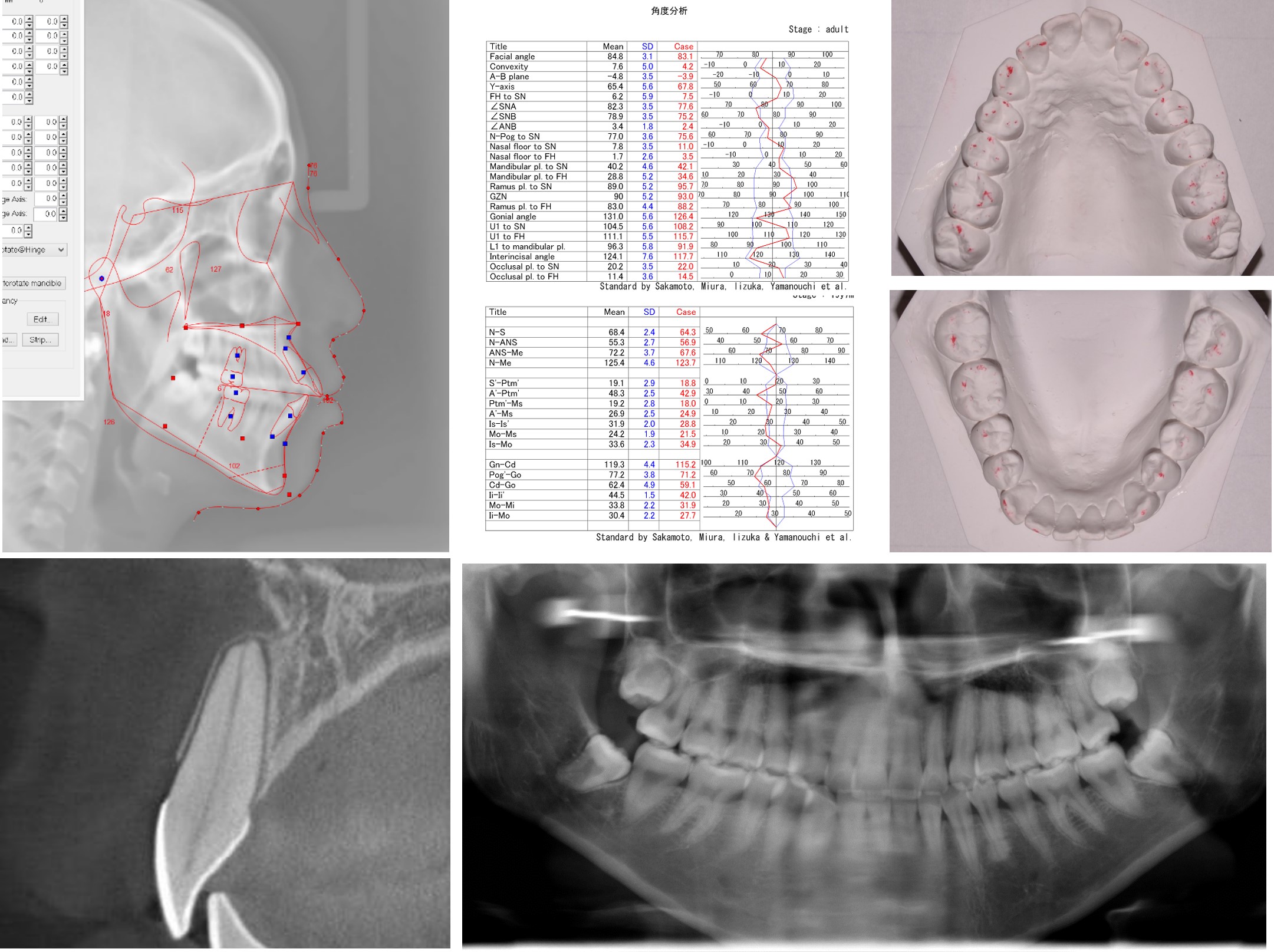 歯のレントゲンと分析資料